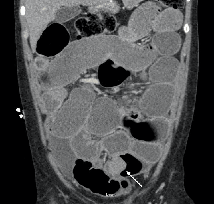 Endometriosis